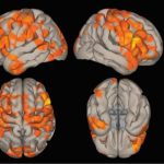 Brain network activity can improve in epilepsy patients after surgery