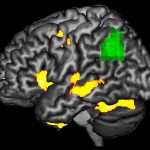 Detecting dementia’s damaging effects before it’s too late
