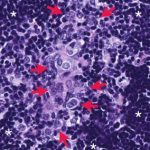 Prostate Cancer Target Blockade Tackles Elusive Onocogene